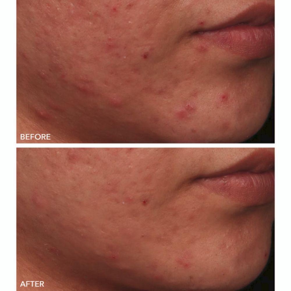 Before and after treatment showing a reduction in acne and redness on the face.