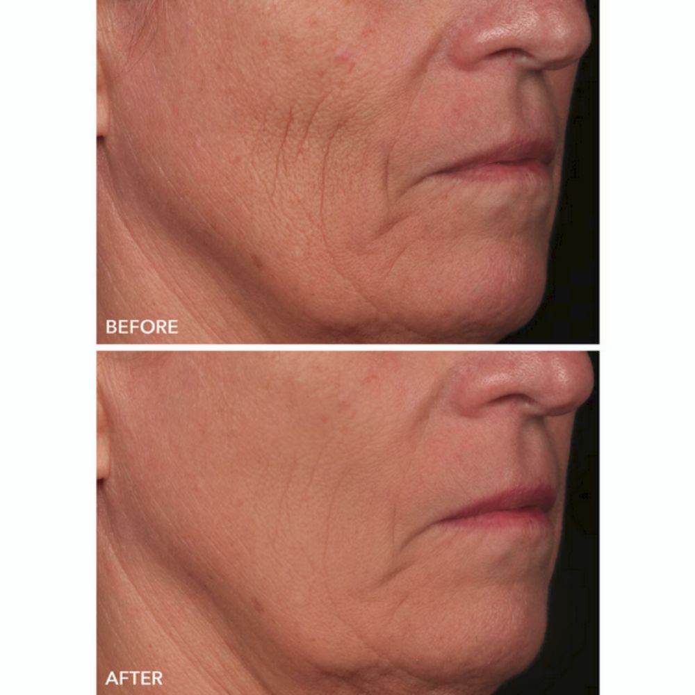 Before and after treatment showing a reduction in wrinkles and improvement in skin texture around the mouth and cheek area.