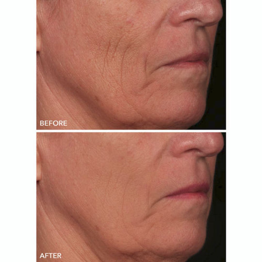 Before and after treatment showing a reduction in wrinkles and improvement in skin texture around the mouth and cheek area.